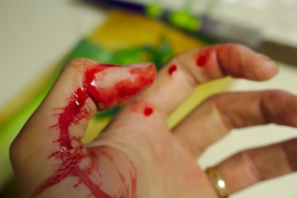 En hand med färskt blod på fingrar och handflata, troligen från ett sår.